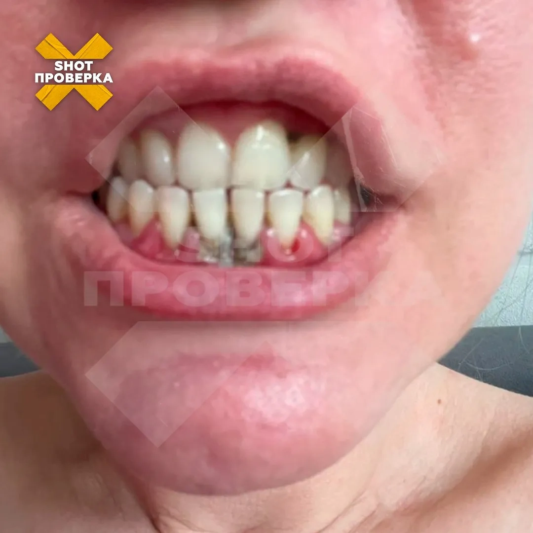 Россияне портят зубы дешёвыми приборами из-за дорогих ортодонтов. Фото © Telegram/ SHOT ПРОВЕРКА