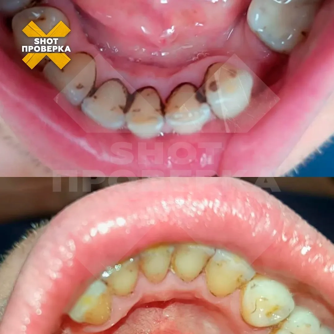 Россияне портят зубы дешёвыми приборами из-за дорогих ортодонтов. Фото © Telegram/ SHOT ПРОВЕРКА