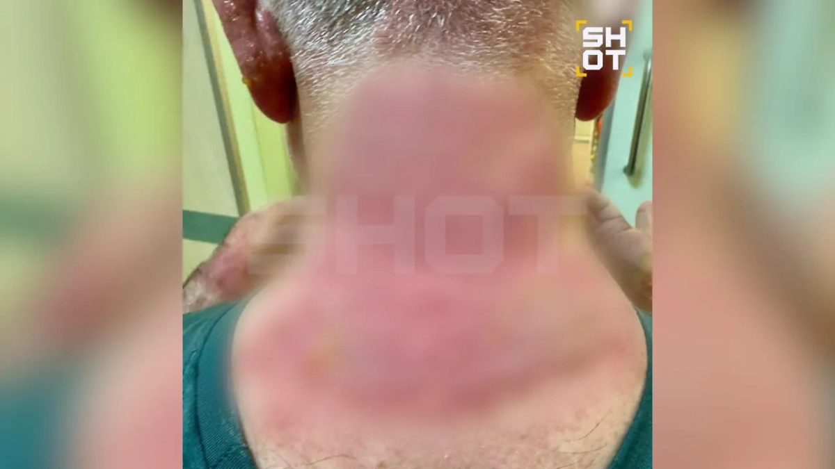 Москвич спрятался в кустах от дождя и попал в больницу с химическими ожогами. Фото © SHOT