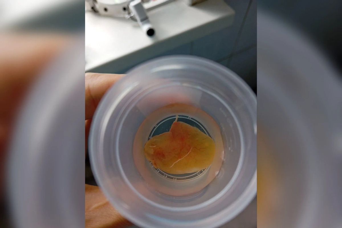 Врачи удалили грибковое новообразование из носа пациентки. Обложка © Минздрав Московской области