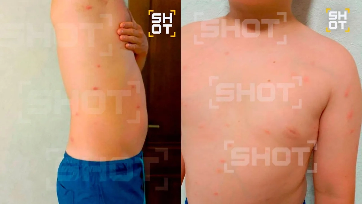 Мальчик с церкариозом. Фото © Telegram / SHOT