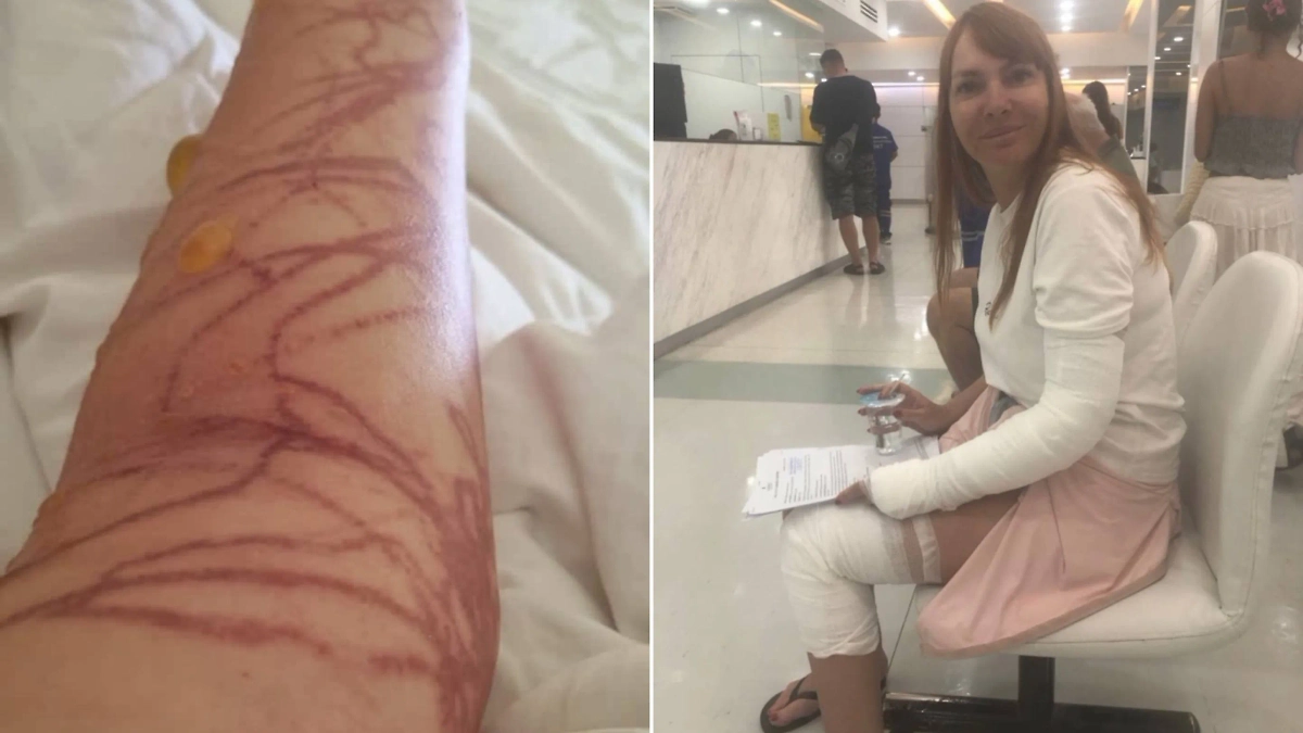 Иркутянка получила анафилактический шок после укуса ядовитой медузы во Вьетнаме. Обложка © Telegram / Thai_Maman_red