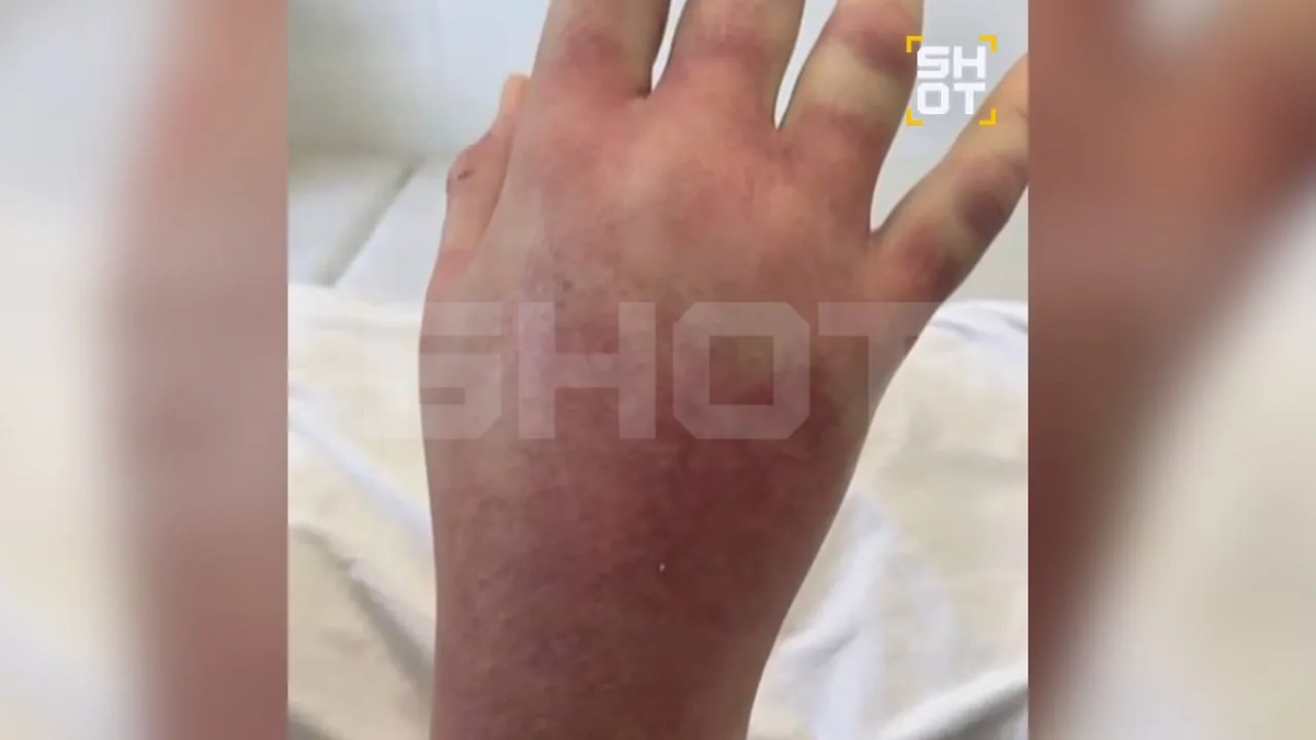 Последствия укуса змеи в Подмосковье. Фото © Telegram / SHOT
