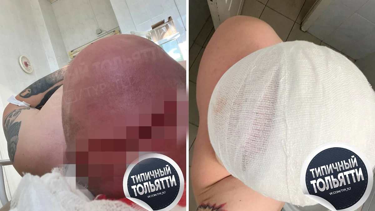 Мужчина нырнул в Волгу и раскроил голову от уха до уха. Фото © Telegram / Типичный Тольятти