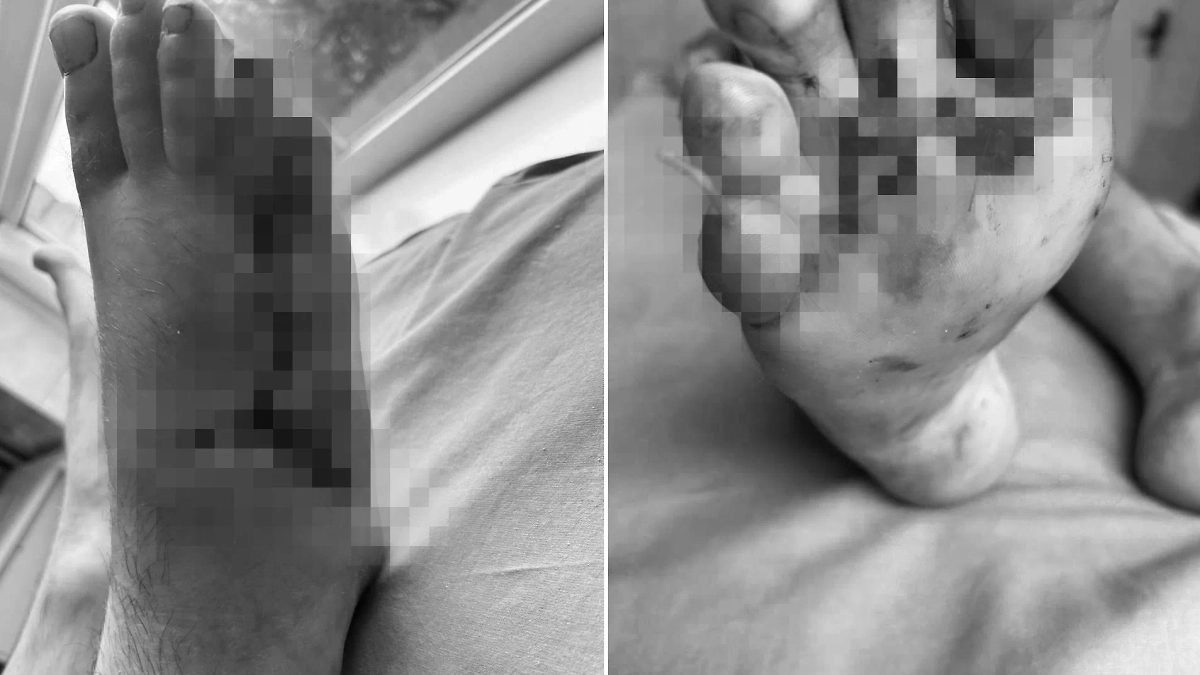 Мужчину в Мытищах спасли травматологи после падения каменной плиты на ногу. Фото © Минздрав Московской области.