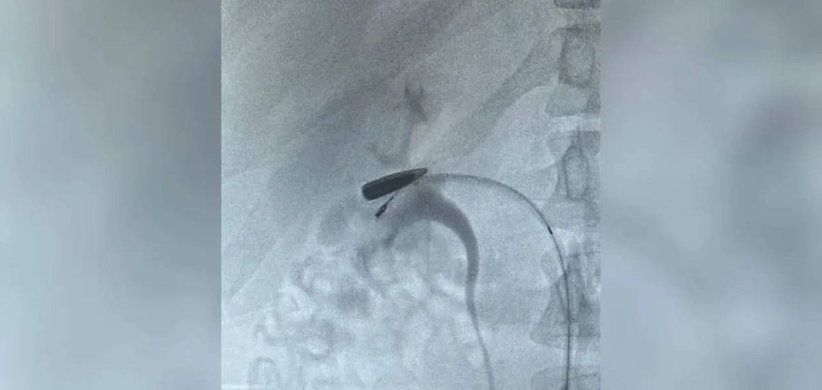 Из Курской области в Москву доставили раненого с пулей в вене. Обложка © Telegram / Московская медицина
