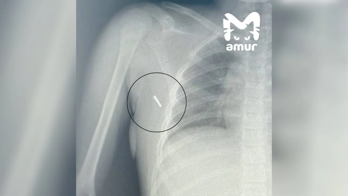 Рентгеновский снимок пострадавшей в Приморье. Фото © Telegram / Amur Mash