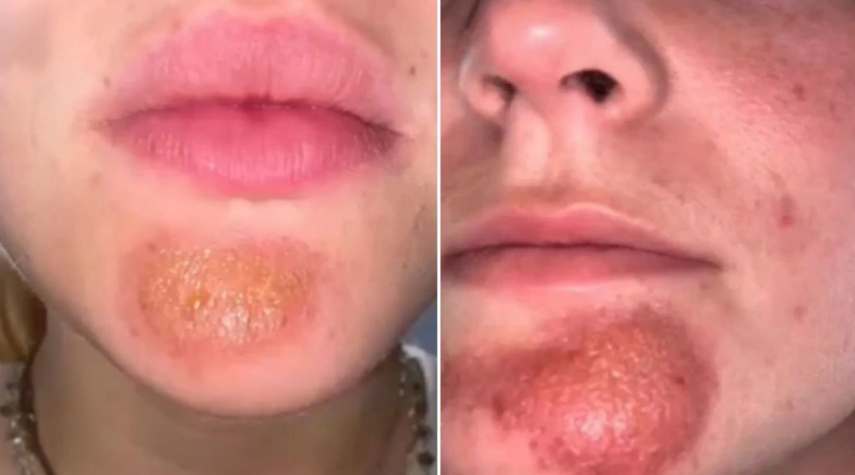 Заболевания на коже лица после поцелуя с бородачом. Фото © Telegram / SHOT ПРОВЕРКА