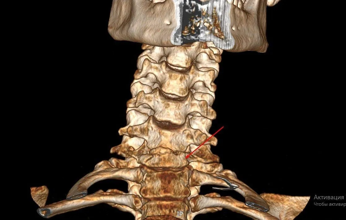 Пациента выписали уже через несколько дней, он уже может ходить. Фото © VK / Минздрав Московской области