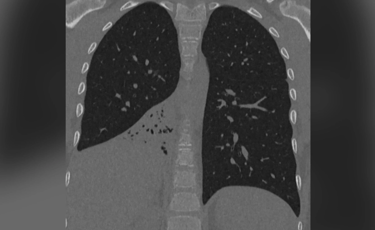 У мальчика в лёгких нашли инородное тело и воспаление. Фото © Предоставлено Life.ru