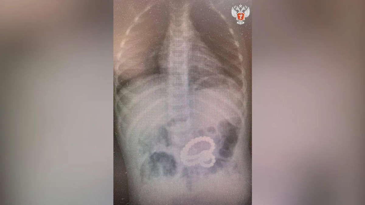 Магниты в желудке мальчика. Фото © Telegram / Минздрав России