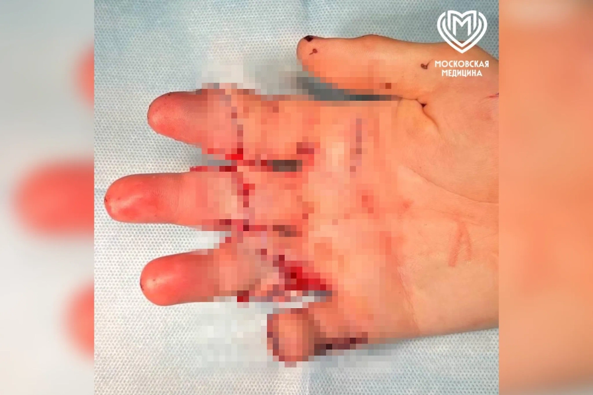 Московские врачи вернули молодому человеку три пальца после травмы на работе. Фото © Депздрав Москвы