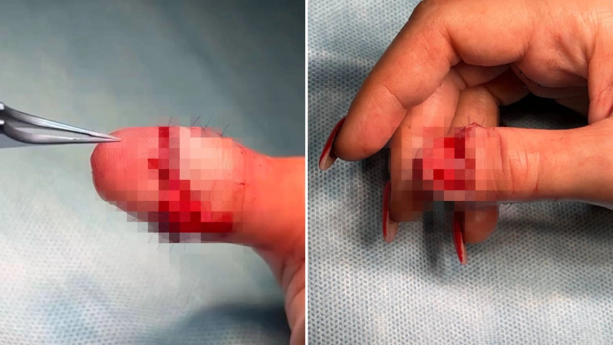 Палец удалось спасти в результате операции, которая длилась 4 часа. Фото © Предоставлено Life.ru