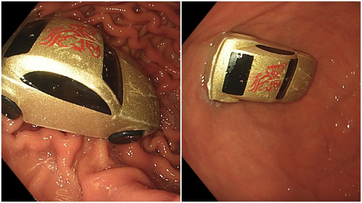 Машинку обнаружили в желудке мальчика. Фото © Министерство здравоохранения Московской области