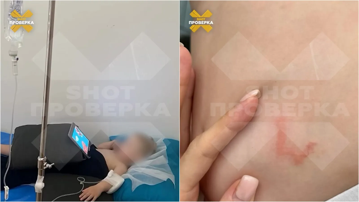 Под кожей ребёнка завёлся червь. Фото © Telegram / SHOT ПРОВЕРКА