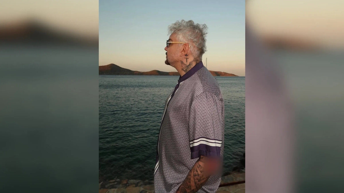 Ожог Филиппа Киркорова. Фото © Telegram / Филипп Киркоров