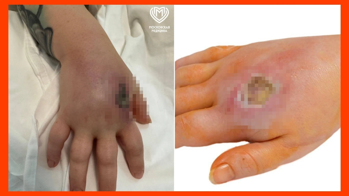 Последствия укуса кобры. Фото © Telegram / Московская медицина