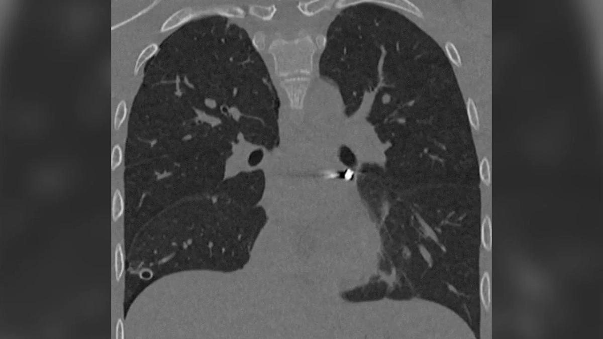 Хирурги Центра Рошаля спасли подростка с пулей в сердце. Фото © Минздрав Московской области