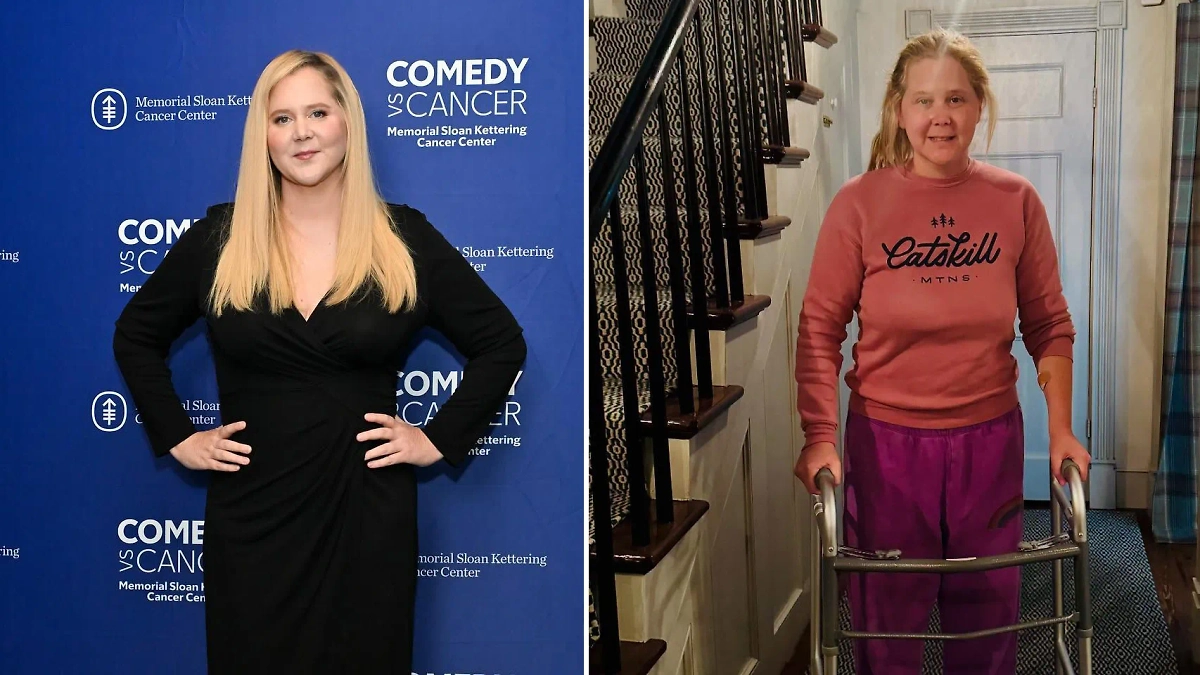 Актриса Эми Шумер до и после операции на позвоночник. Обложка © Instagram (признан экстремистской организацией и запрещён на территории Российской Федерации)/ amyschumer