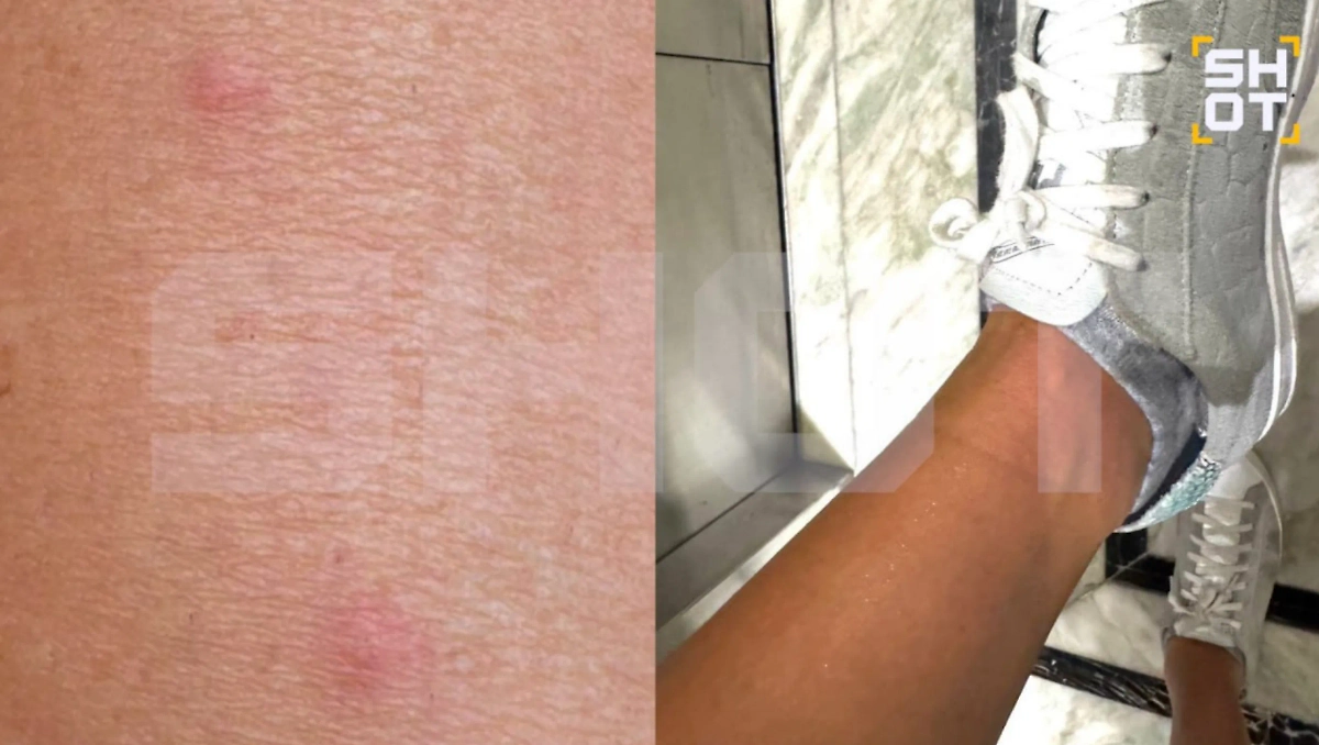 Последствия укусов. Фото © SHOT