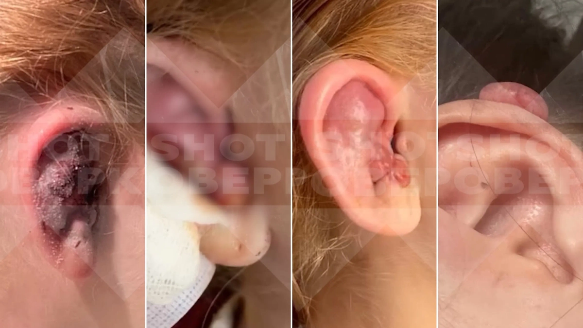 После пирсинга у женщин из Орска начались гнойные воспаления и операции. Фото © Telegram / SHOT ПРОВЕРКА