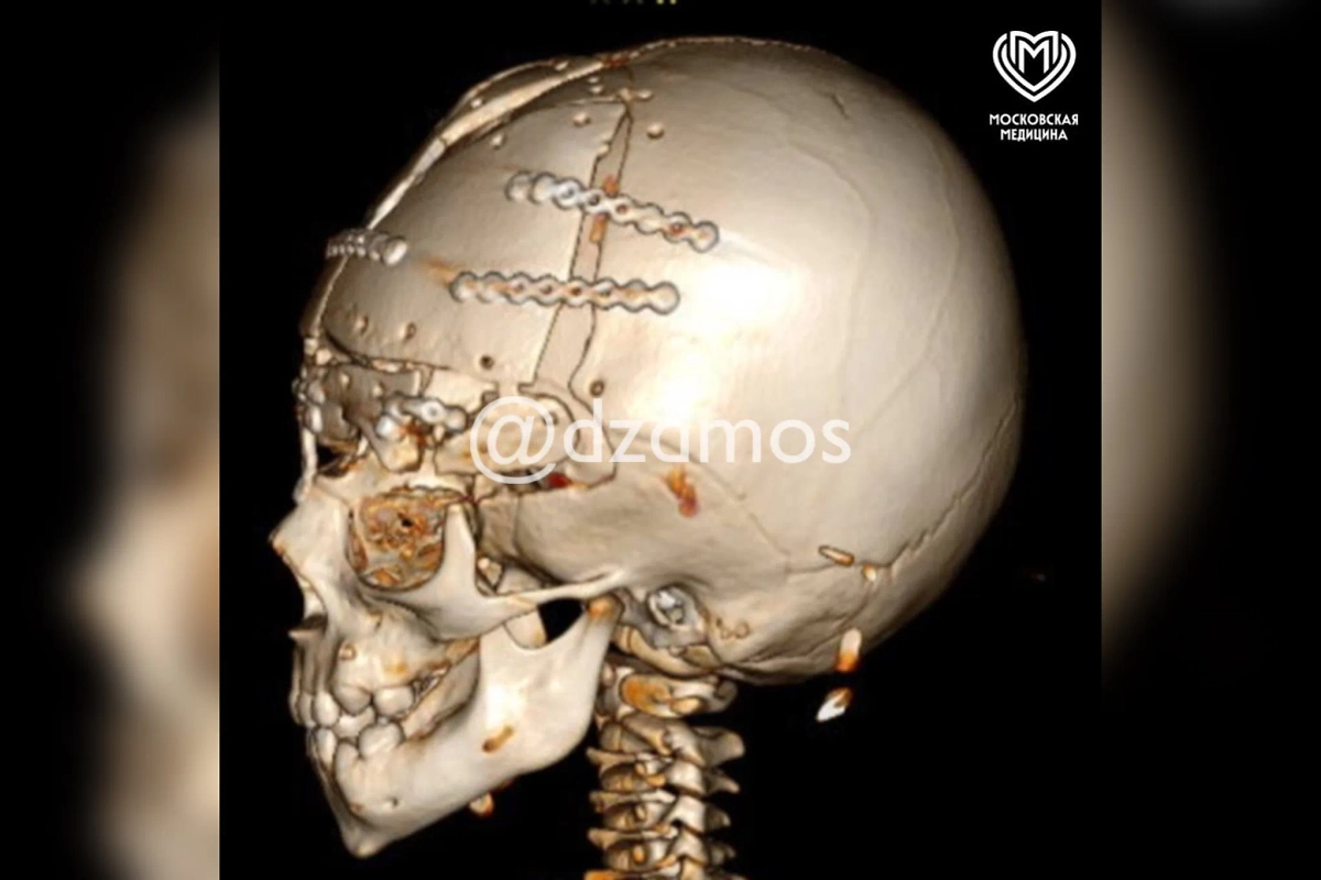 Рентген мальчика. Фото © Telegram / «Московская медицина»