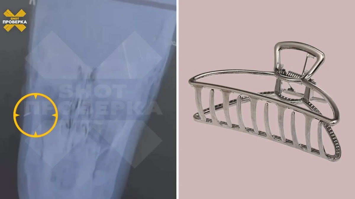 Рентген и заколка, которая впилась в щёку пострадавшей. Фото © Telegram / SHOT ПРОВЕРКА