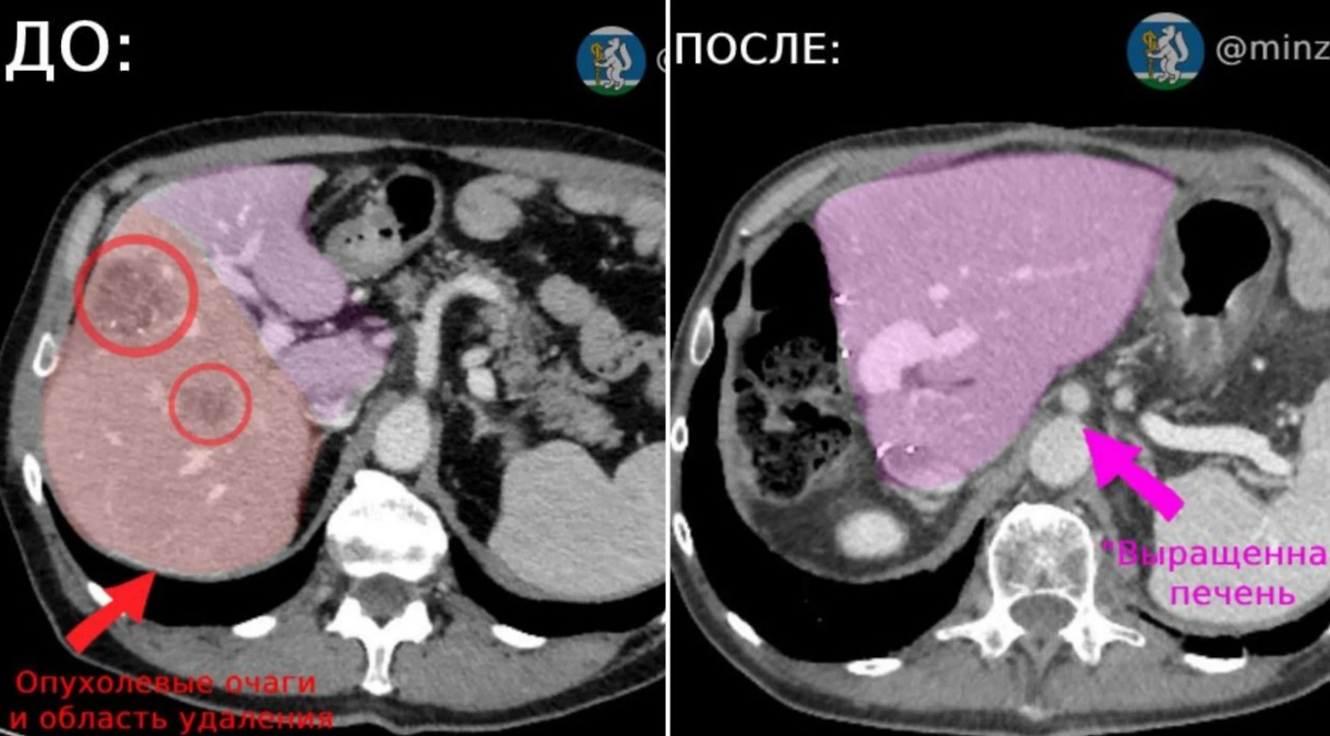 Печень пациента. Фото © VK / Минздрав Свердловской области