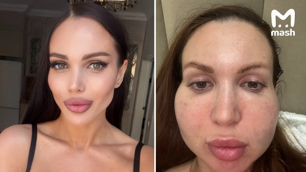 Лицо крымчанки превратилось в грушу после дешёвого косметолога из Астаны. Обложка © Telegram/ Mash