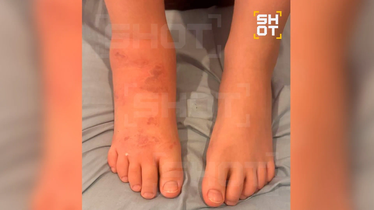 Оставшиеся от ожогов шрамы. Фото © SHOT