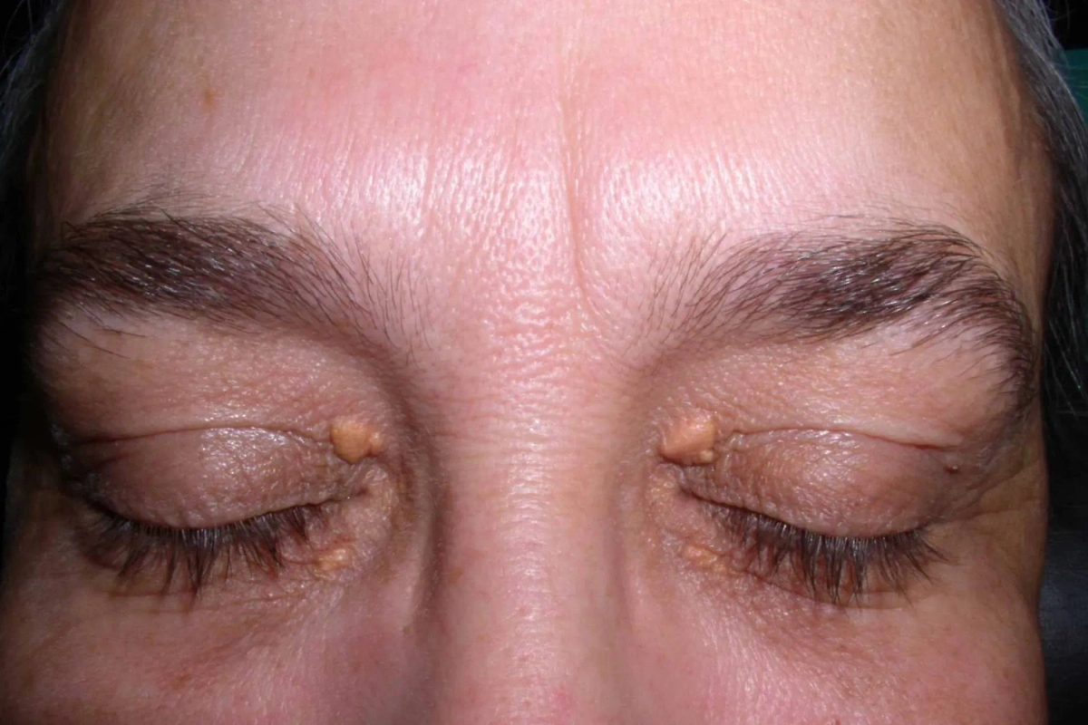 Признаки заболеваний на лице: как распознать болезнь по внешности. Фото © Wikipedia / Klaus D. Peter, Wiehl, Germany