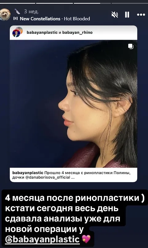 Полина Аксёнова, дочь Даны Борисовой, сделала уже три пластические операции. Фото © Instagram (признан экстремистской организацией и запрещён на территории Российской Федерации) / poxenovaaa