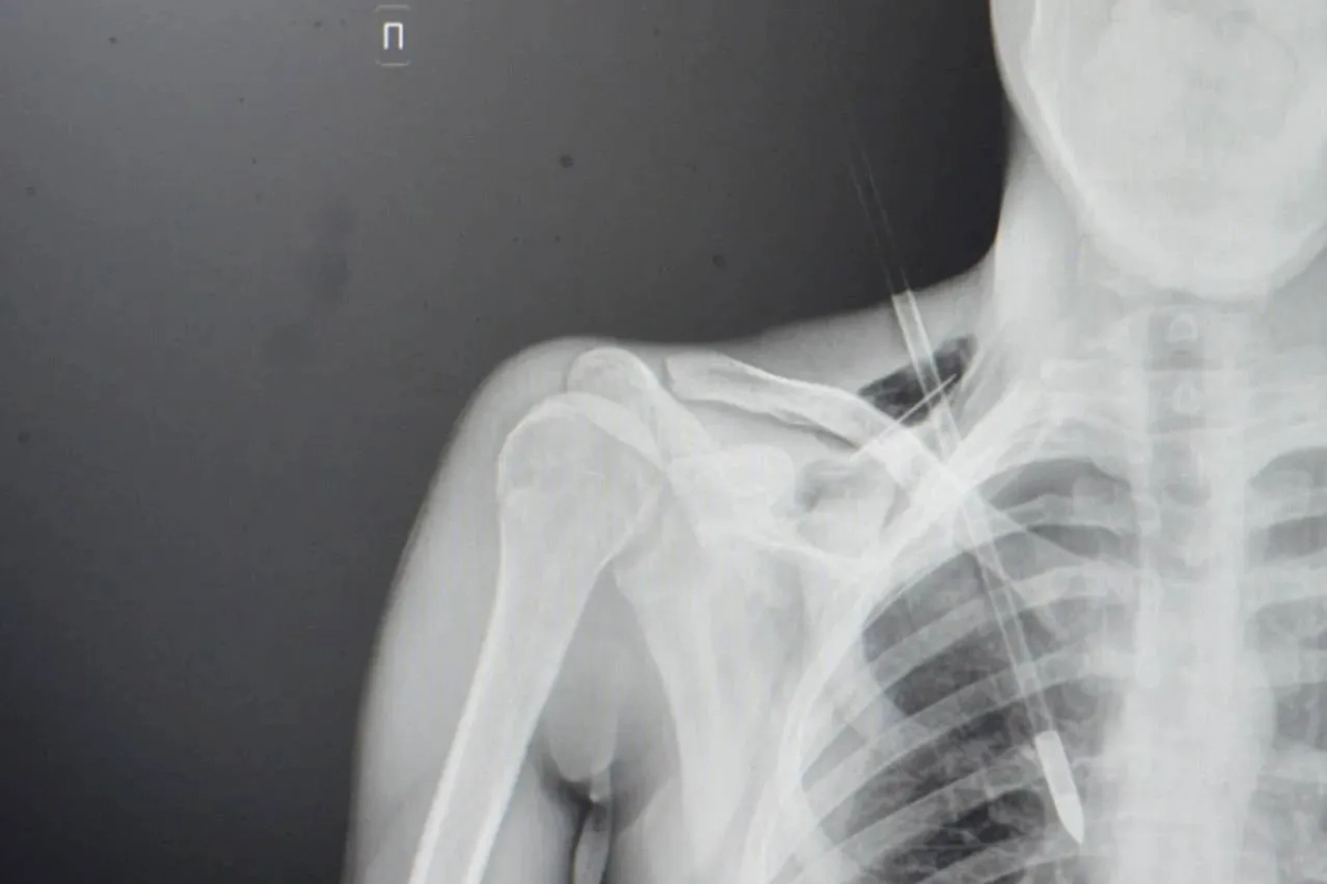 Стрела в грудной клетке. Фото © Министерство здравоохранения Московской области