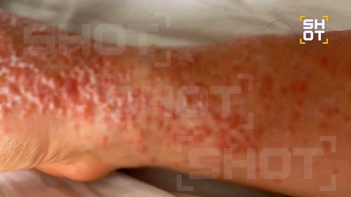 Аллергия россиянина. Фото © SHOT