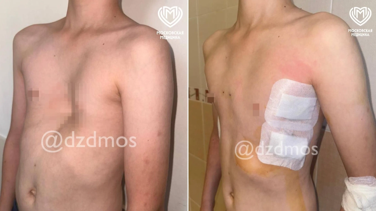 Мальчик до и после операции. Фото © Telegram / Московская медицина