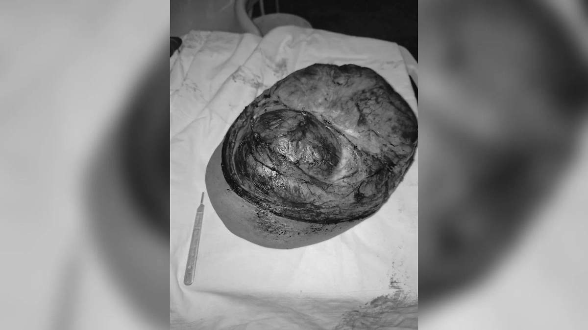 В Кировской области хирурги удалили 65-летнему мужчине опухоль на шее размером с голову. Фото © VK / Минздрав Кировской области