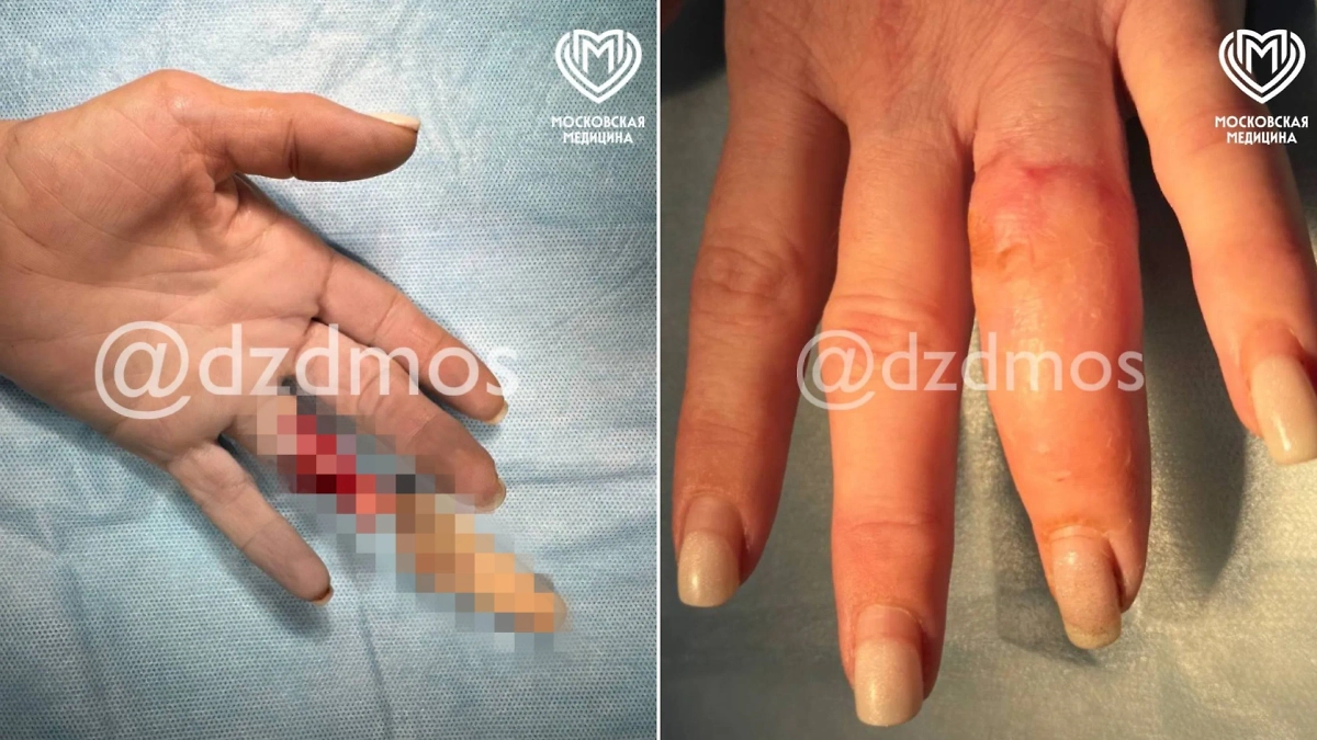 Женщине в Москве ампутировало палец кольцом — врачи успешно провели операцию. Фото © Telegram / Московская медицина