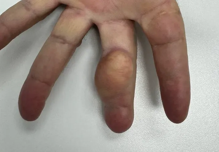 Опухоль на пальце мужчины. Обложка © Минздрав Московской области