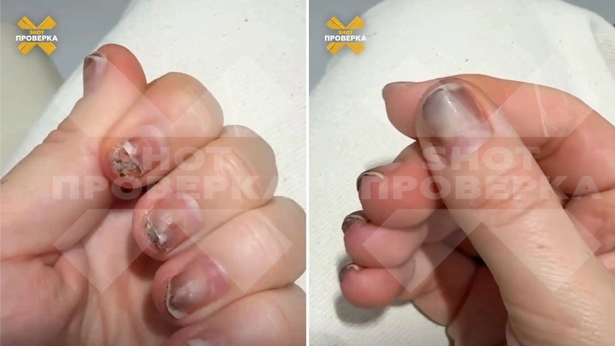 Петербурженке сожгли все ногти в салоне. Фото © Telegram / SHOT ПРОВЕРКА