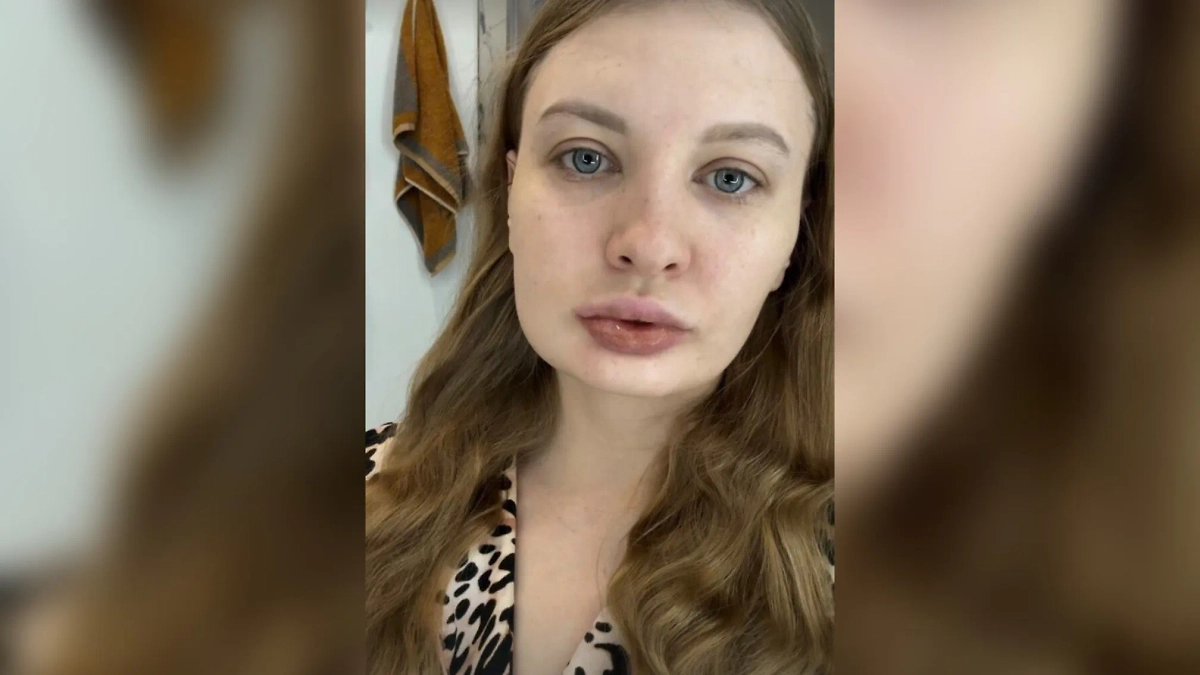 Мелисса после операции. Фото © Instagram (соцсеть запрещена в РФ; принадлежит корпорации Meta, которая признана в РФ экстремистской) / melissa_foxs