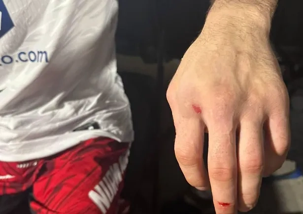 Перелом Умара Нурмагомедова. Обложка © Х / aliabdelaziz00