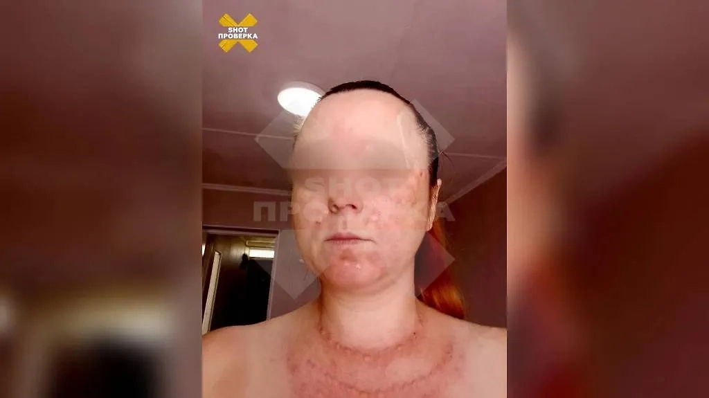 Последствия домашних уколов «сывороткой молодости». Фото © SHOT ПРОВЕРКА