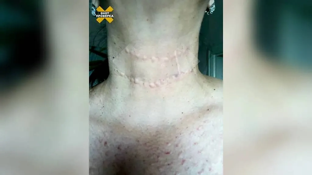Последствия домашних уколов «сывороткой молодости». Фото © SHOT ПРОВЕРКА