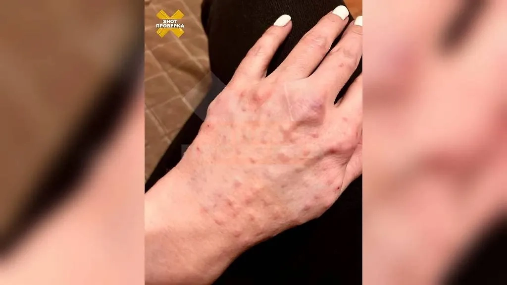 Последствия домашних уколов «сывороткой молодости». Фото © SHOT ПРОВЕРКА