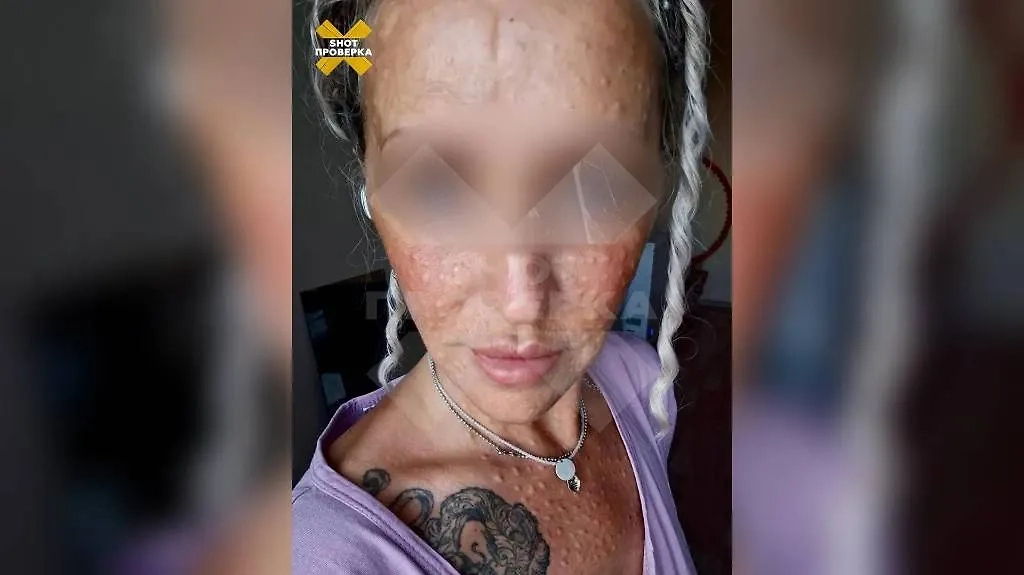 Последствия домашних уколов «сывороткой молодости». Фото © SHOT ПРОВЕРКА