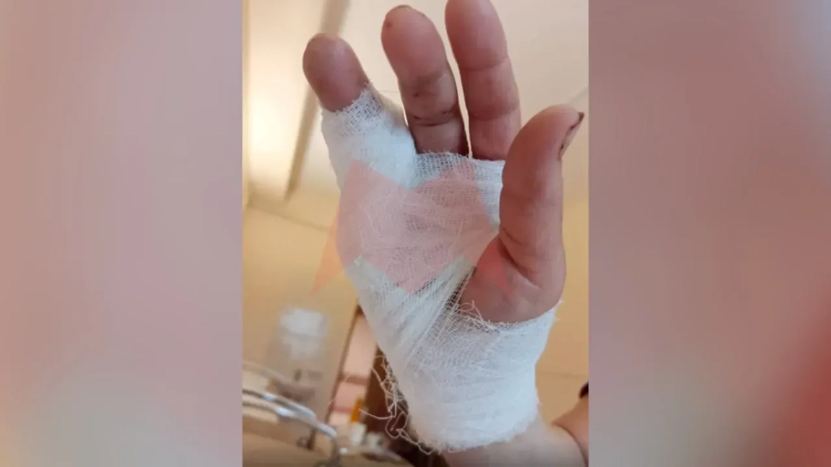 Палец москвички, спасавшей собаку. Обложка © Telegram / «Новости Москвы»