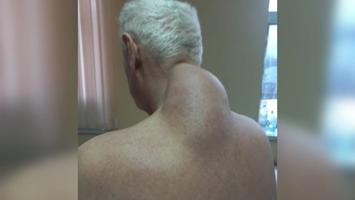 Полуторакилограммовая липома у 74-летнего мужчины. Фото © VK / Долгопрудненская больница