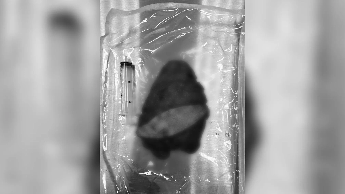 Полуторакилограммовая липома. Фото © VK / Долгопрудненская больница