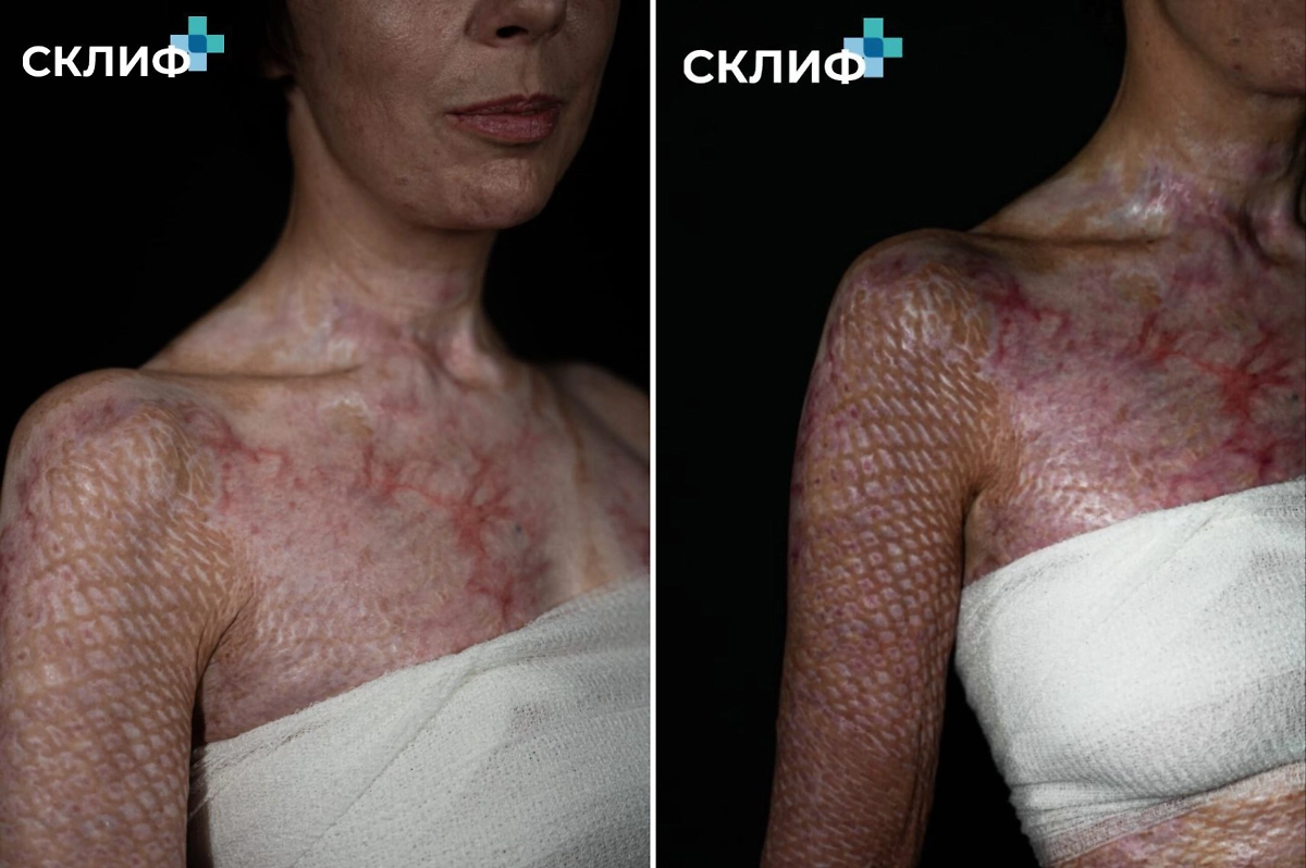 Последствия лечения ожогов. Фото © Telegram / Пресс-служба «Склифа»