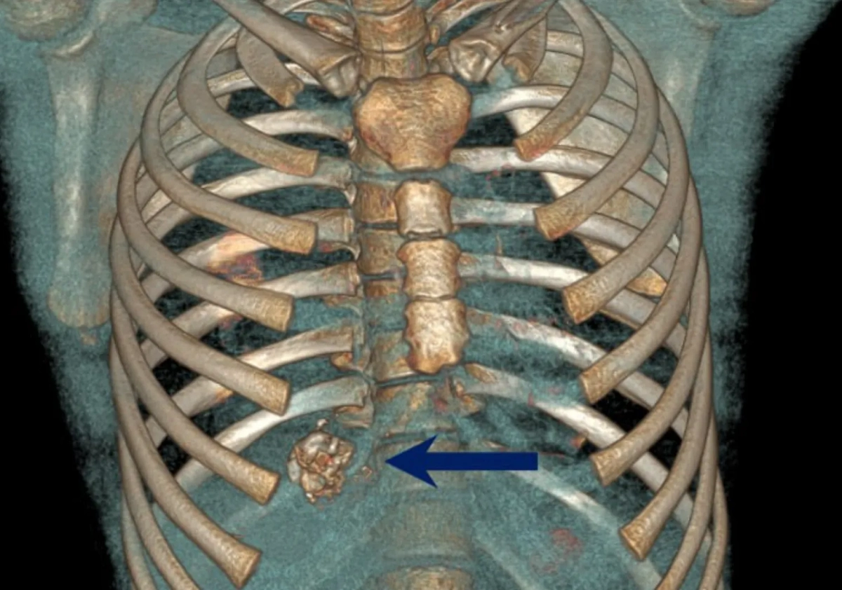 Подросток травмировался при взрыве петарды. Обложка © Telegram / Ивано-Матренинская детская клиническая больница